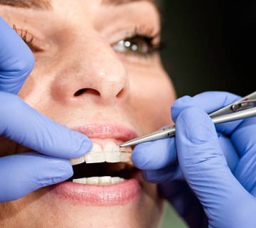 invisible ceramic braces