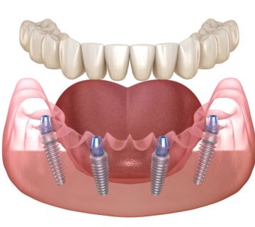 mandibular prosthesis all on 4 system supported by implants medically accurate 3d 3