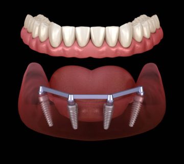 mandibular prosthesis with gum all on 4 system supported by implants medically accurate 3d 2