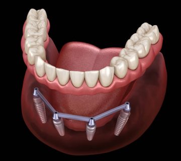 mandibular prosthesis with gum all on 4 system supported by implants medically accurate 3d 3