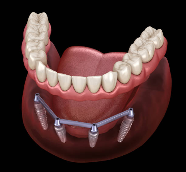 mandibular prosthesis with gum all on 4 system supported by implants medically accurate 3d