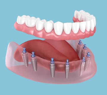 mandibular prosthesis with gum all on 8 system supported by implants 3d illustration