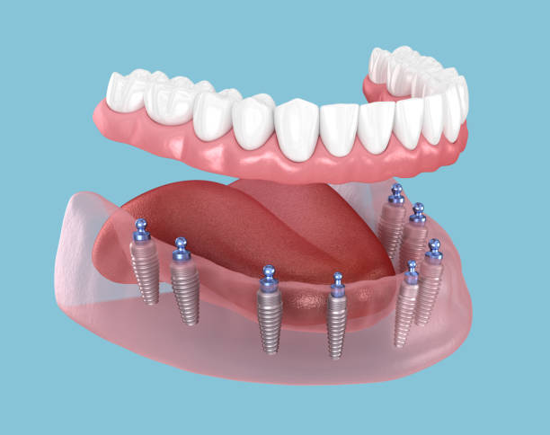 mandibular prosthesis with gum all on 8 system supported by implants 3d illustration