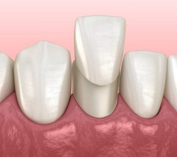 mandibular veneer installation procedure over lateral incisor medically accurate tooth 3d