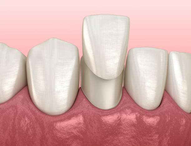 mandibular veneer installation procedure over lateral incisor medically accurate tooth 3d