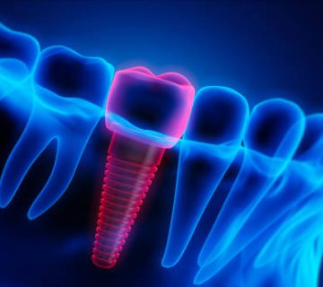 medical visualization dental implant in the jaw 2