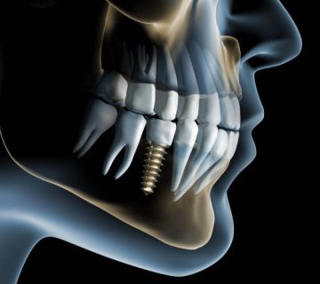 medical visualization dental implant in the jaw 3d rendering 2