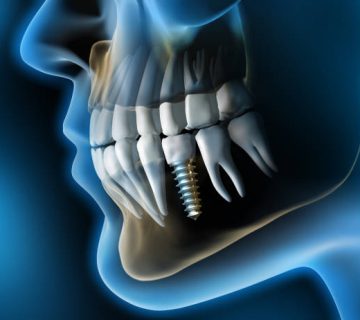 medical visualization dental implant in the jaw 3d rendering 3