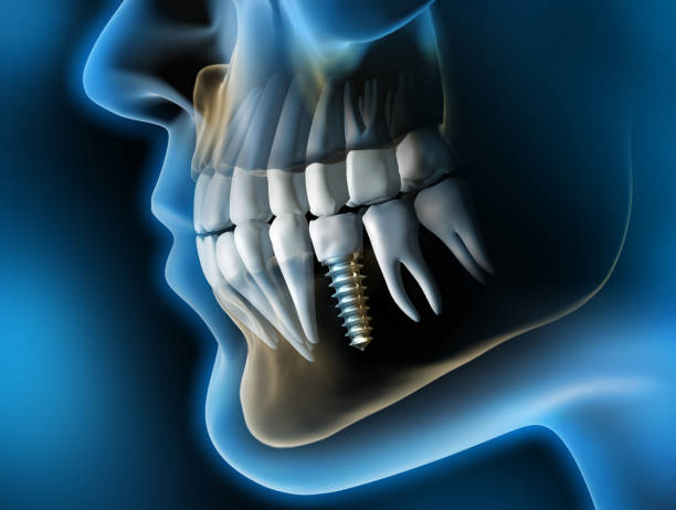 medical visualization dental implant in the jaw 3d rendering 3
