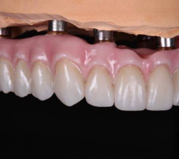 mesmerizing beauty of ceramic implants aesthetic close up with artificial gum on black 1