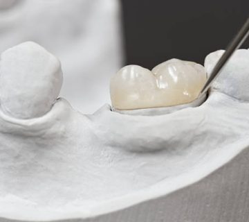 placement of a dental inlay on a cast model using a tool