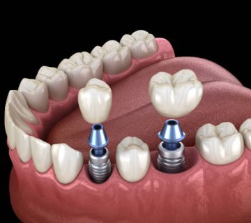 premolar and molar tooth crown installation over implant screw fixation 3d illustration of 2