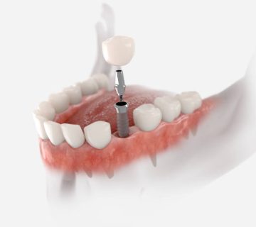 premolar tooth implant 2