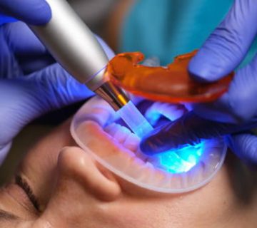 restoration of teeth with filling polymerization lamp