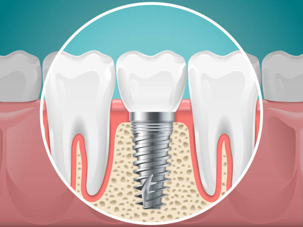 stomatology illustrations dental implants and healthy teeth