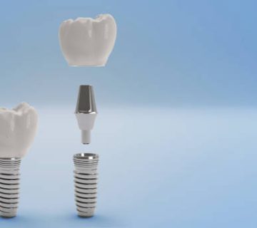 teeth implant 2