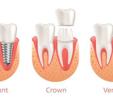 teeth procedure implant veneer crown restoration