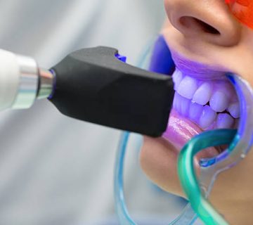 tooth filling ultraviolet lamp