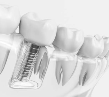 tooth human implant 3d rendering 1