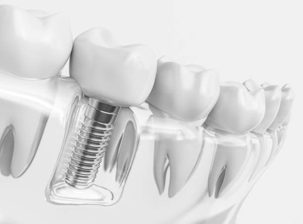 tooth human implant 3d rendering 1