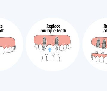 types of dental implants to replace one tooth multiple teeth and all teeth 2