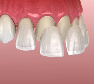 veneer installation procedure over central incisor and lateral incisor medically accurate 1