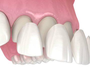 veneer installation procedure over central incisor and lateral incisor medically accurate 2