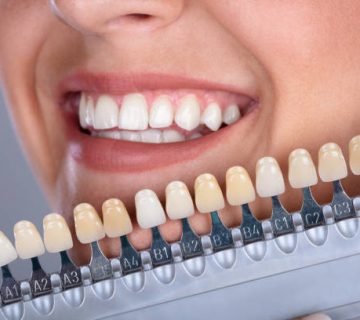 woman matching shade of the implant teeth