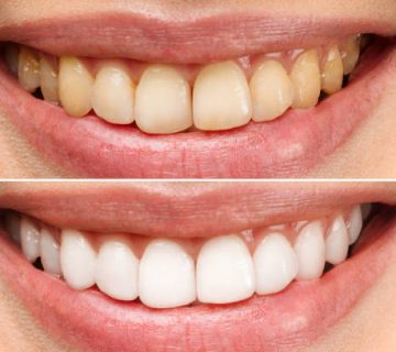 woman teeth before and after whitening over white background dental clinic patient image 1