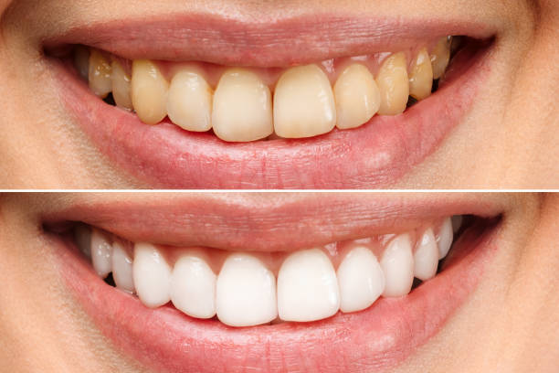 woman teeth before and after whitening over white background dental clinic patient image 1