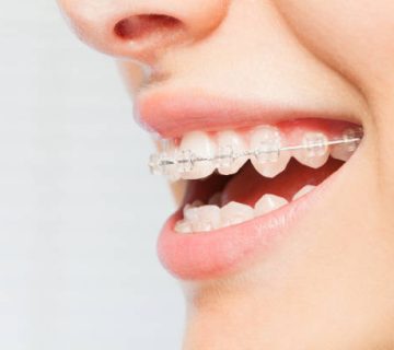 womans smile with clear dental braces on teeth