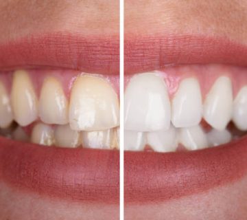 womans teeth before and after whitening