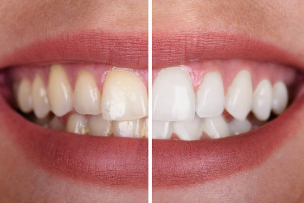 womans teeth before and after whitening