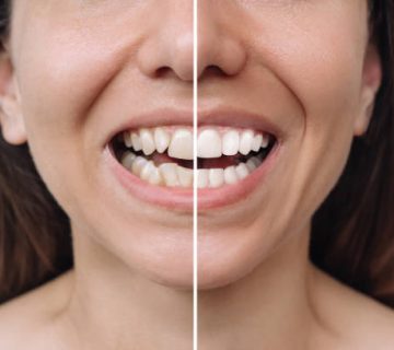 young woman before and after veneers installation correction of uneven teeth with braces