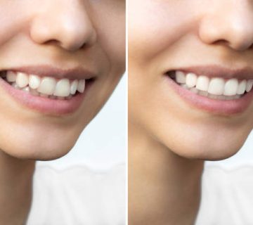 young womans smile before and after teeth straightening 2